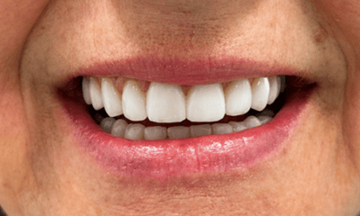 After Composite Veneers