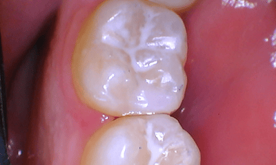 Restoration After