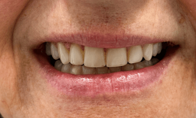 Before Composite Veneers
