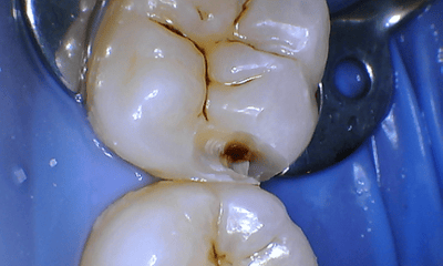 Restoration Before